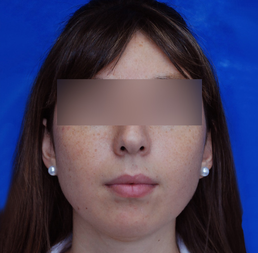 Rinoplastia, Wam Center