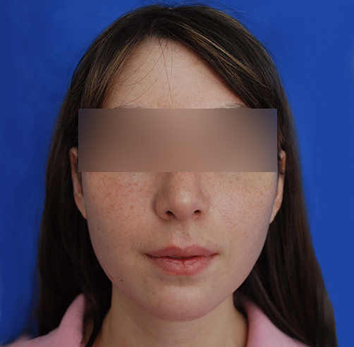 Rinoplastia, Wam Center