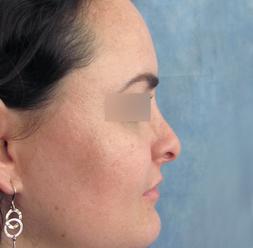 Rinoplastia, Wam Center