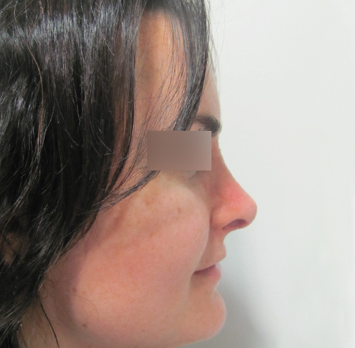 Rinoplastia, Wam Center