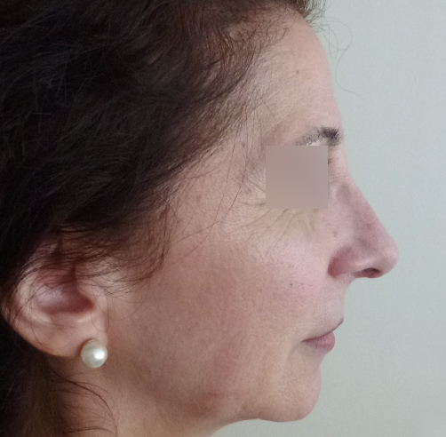 Rinoplastia, Wam Center