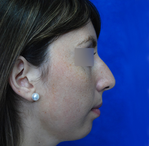 Mentoplastia, Wam Center